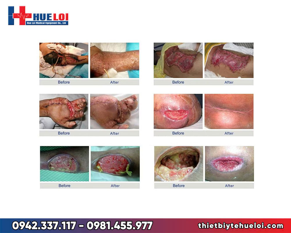 Máy ánh sáng chữa lành vết thương 86s